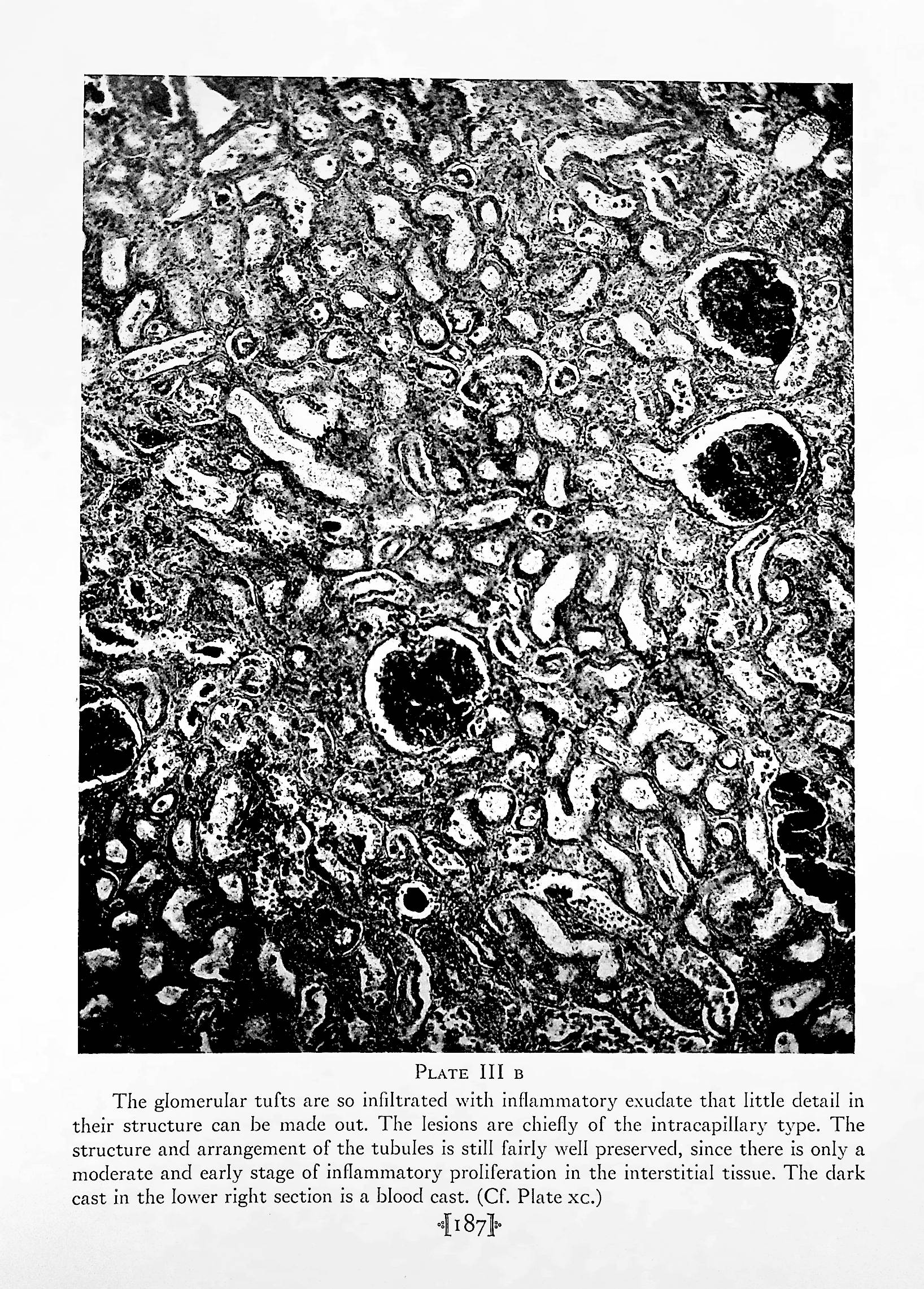 The Renal Lesion In Bright's Disease